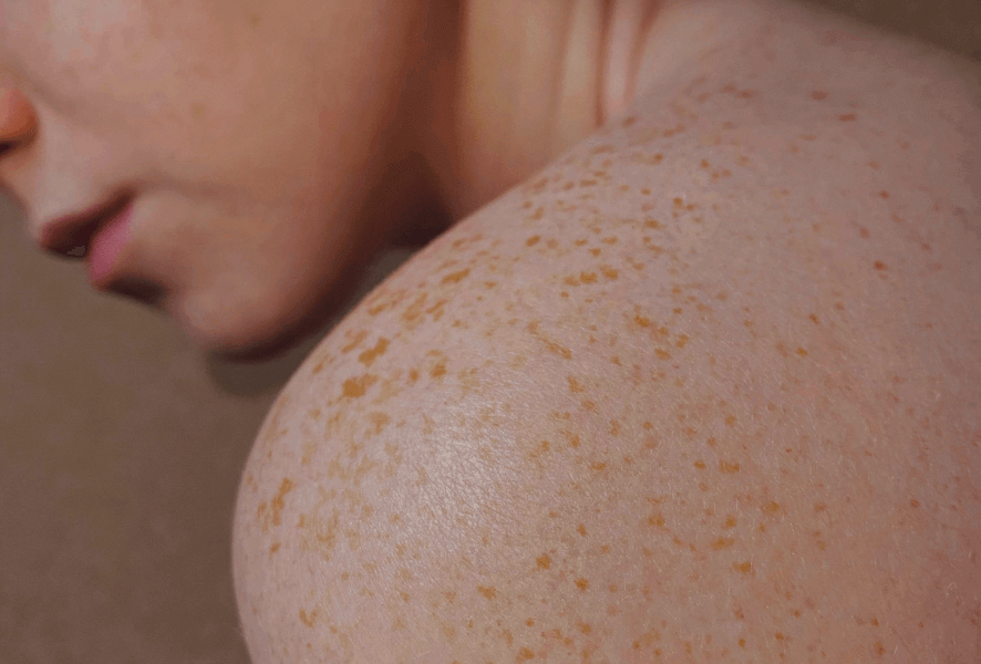 Woman's shoulder with laser skin treatment