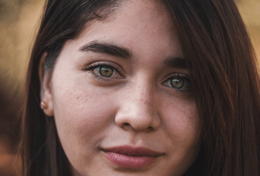 Woman with acne treatment in London