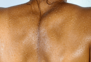 Woman's back with laser skin treatment in London