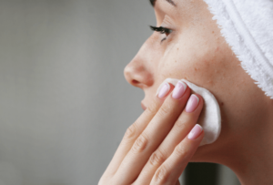 Woman with acne or rosacea in London wiping face with cotton pad