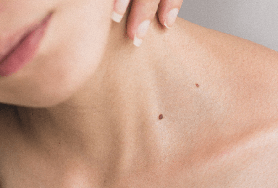 Woman with skin cancer on neck in London