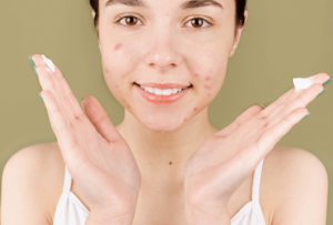 Woman with acne smiling