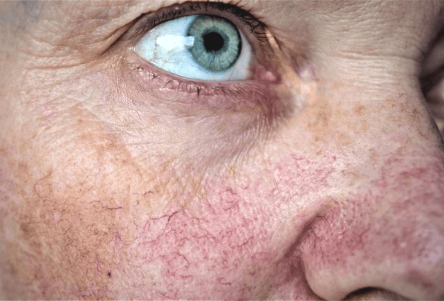 Woman with rosacea on cheeks in Cedars Dermatology