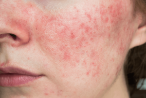 Woman with rosacea in London