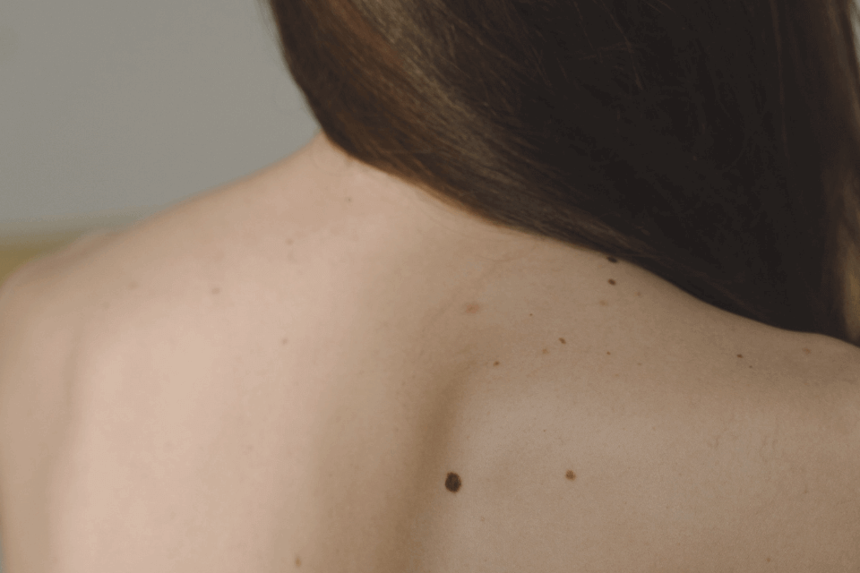 close up of moles on someone's back