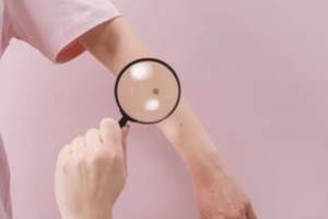 magnifying glass looking at skin cancer on someone's arm