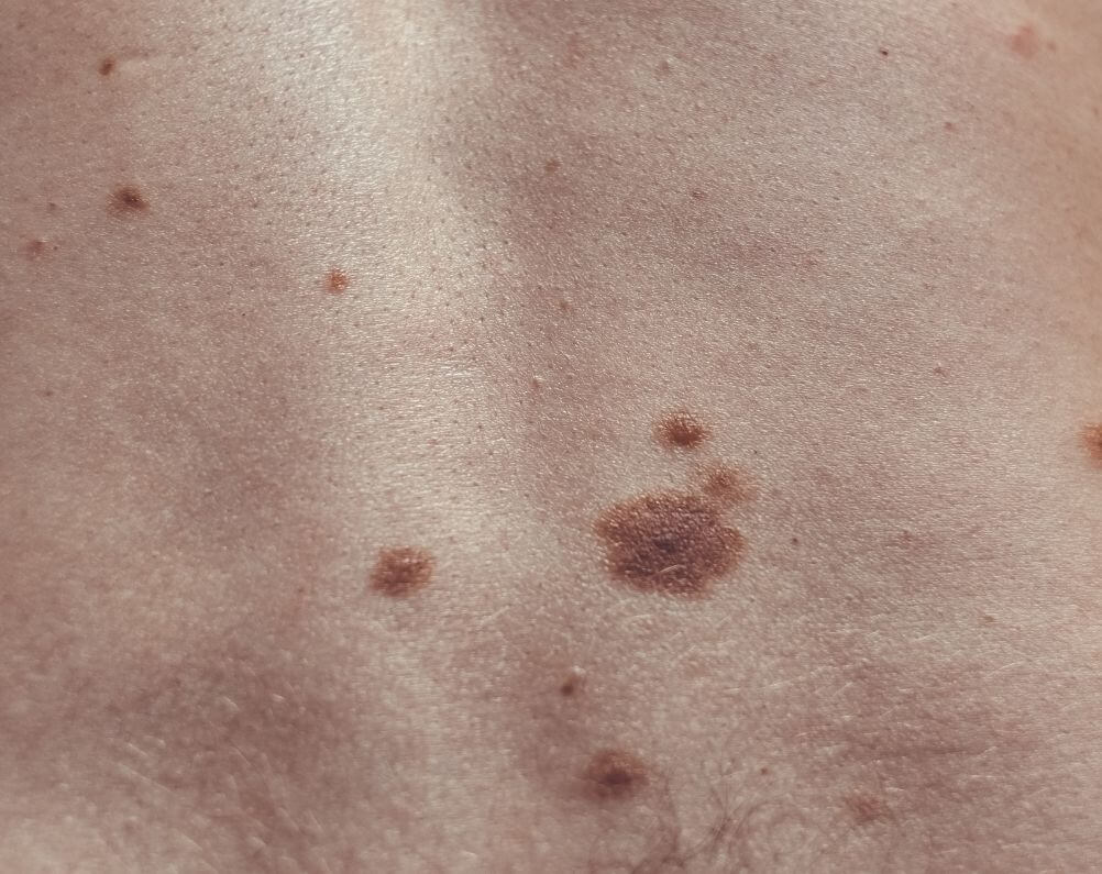 lentigo maligna melanoma