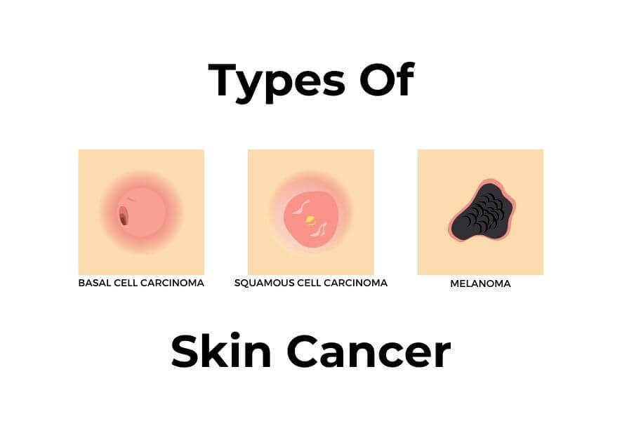 Graphic showing the types of skin cancer